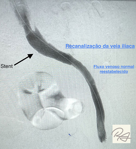 veia ilíaca que estava obstruído foi reconstruído com a utilização do stent