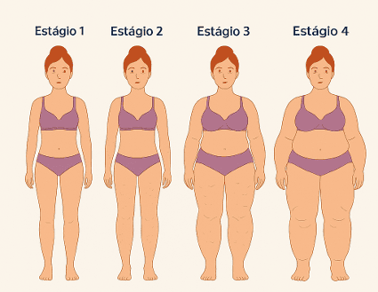 Estágios do Lipedema